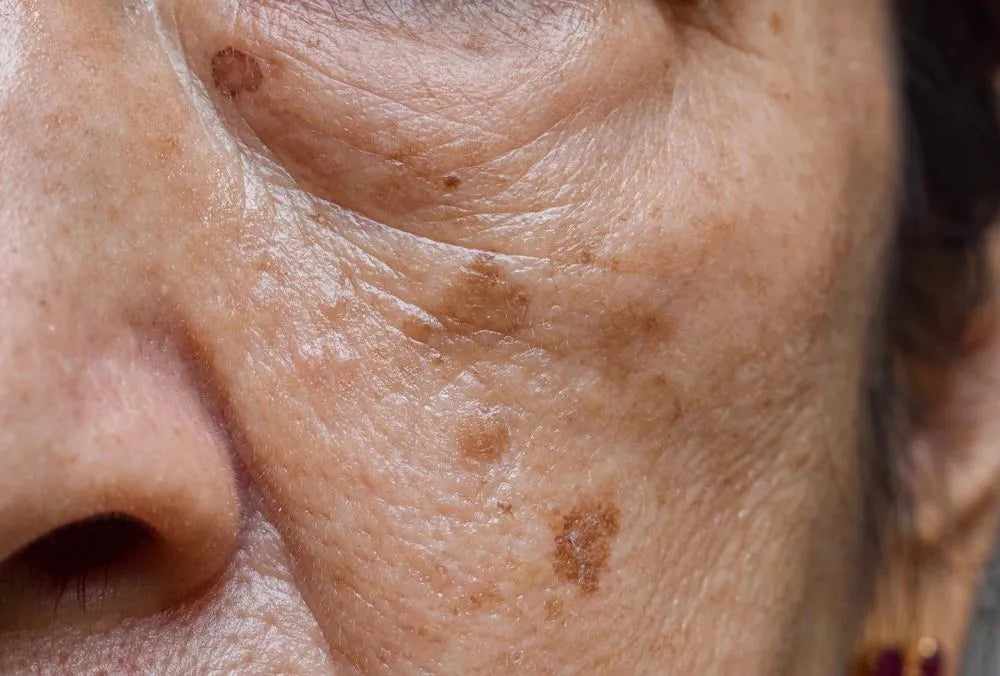 Hoygi Serum - Manchas edad