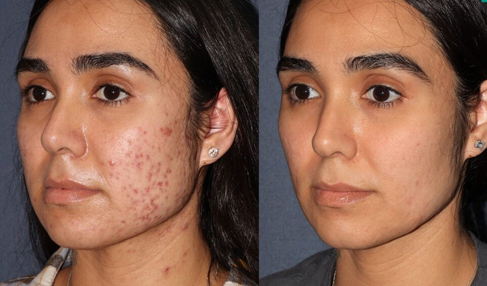 Hoygi Serum - Acné